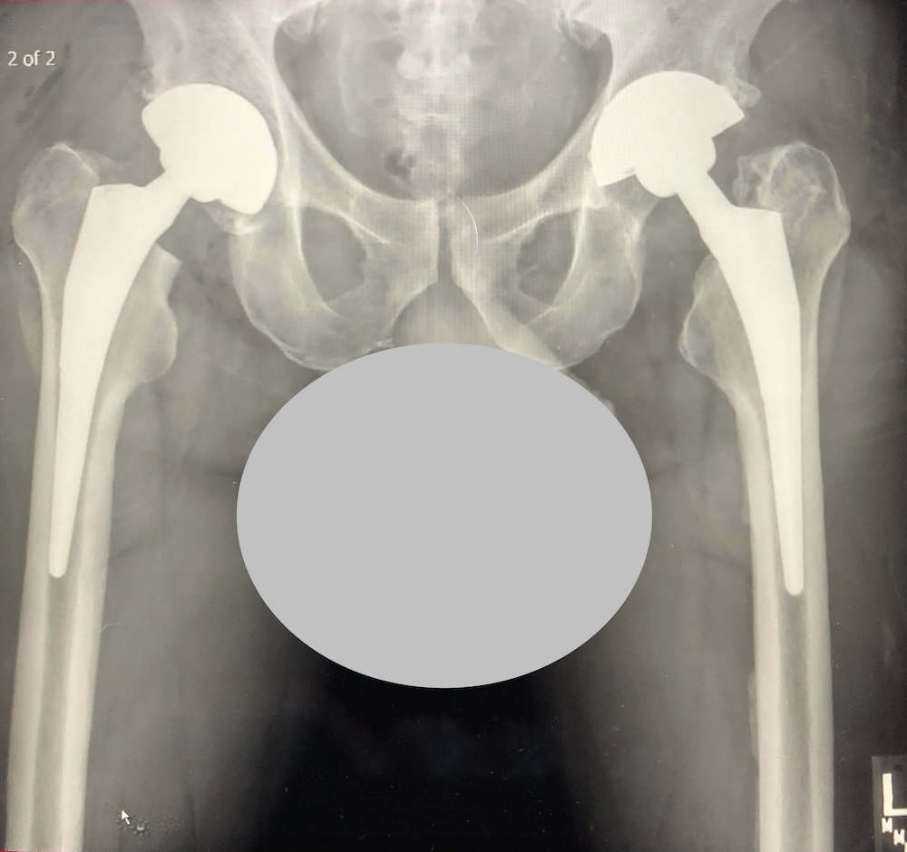 x ray of hip